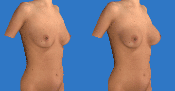 BreastSculptorRotation3